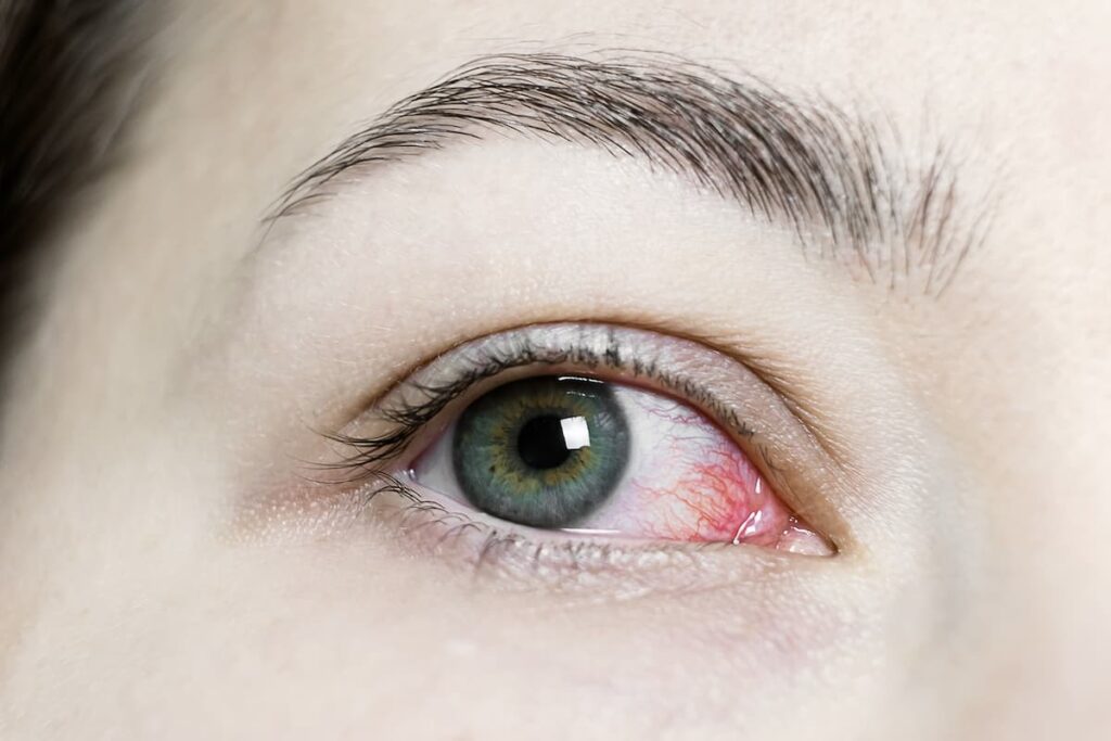 Derrame en el ojo por estrés